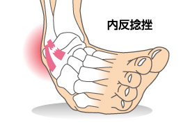 足首の捻挫で靭帯損傷