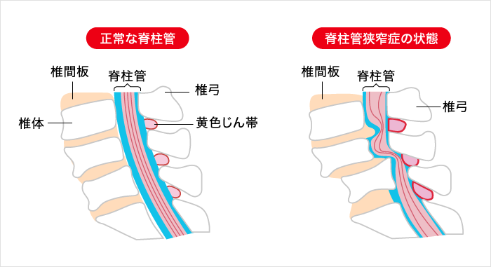 兵庫県尼崎市南武庫之荘のきりん接骨鍼灸院　脊柱管狭窄症の説明