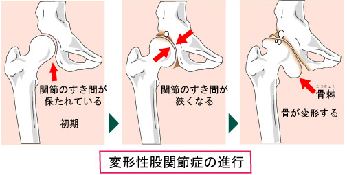 兵庫県尼崎市南武庫之荘のきりん接骨鍼灸院　変形性股関節症