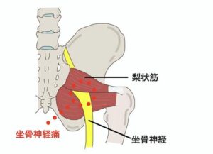 尼崎市南武庫之荘のきりん接骨鍼灸院です。坐骨神経痛