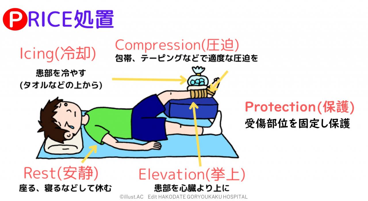 捻挫に対してのＰＲＩＣＥ処置の説明