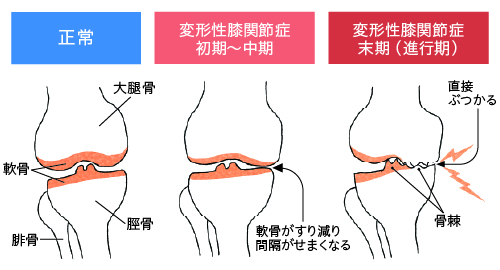 兵庫県尼崎市南武庫之荘のきりん接骨鍼灸院　変形性膝関節症の進行の説明