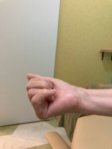 きりん接骨鍼灸院、へバーデン結節