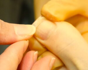尼崎市南武庫之荘の巻き爪補正(ペティグラス式)